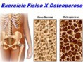 /album/dicas-de-saude/osteoporose-jpg/